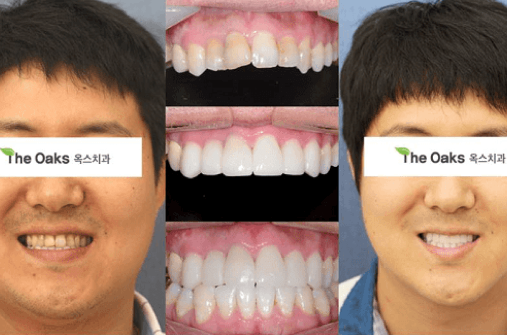 1 Day Dental Veneers – Laser Whitening / Cleaning