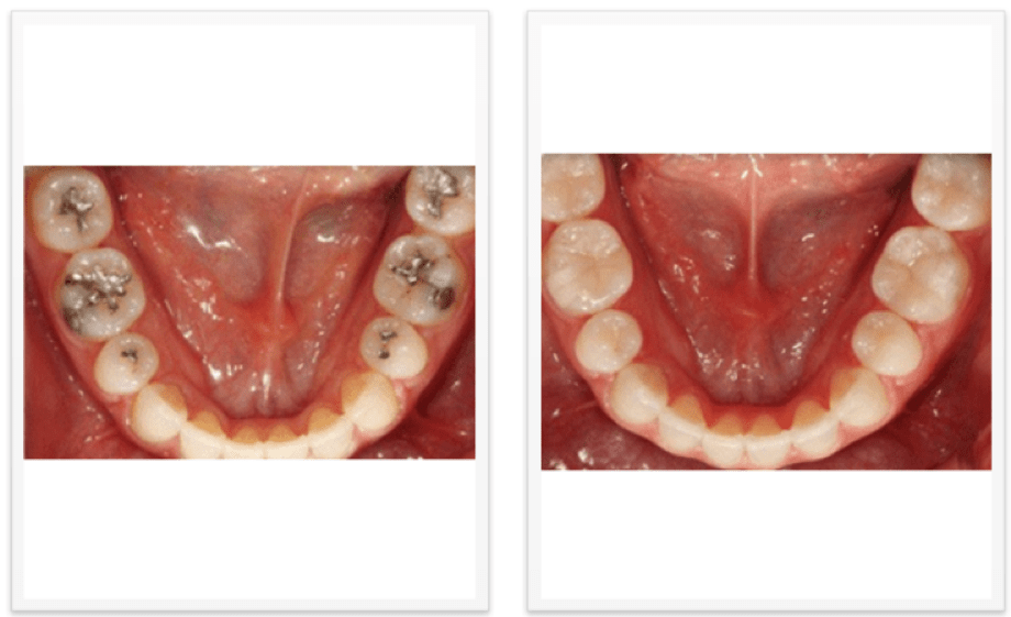 Crowns and Fillings