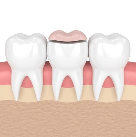 CROWNS AND FILLINGS 512-min