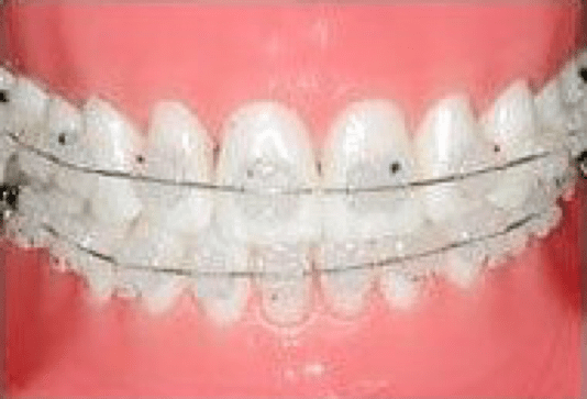 Types & Treatment Time Types & Treatment Time