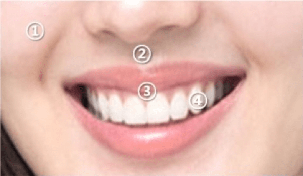 Gummy Smile Procedure (Non-1 Day Procedure) Gummy Smile Procedure (Non-1 Day Procedure)