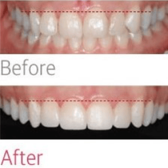 Gum-related Procedures