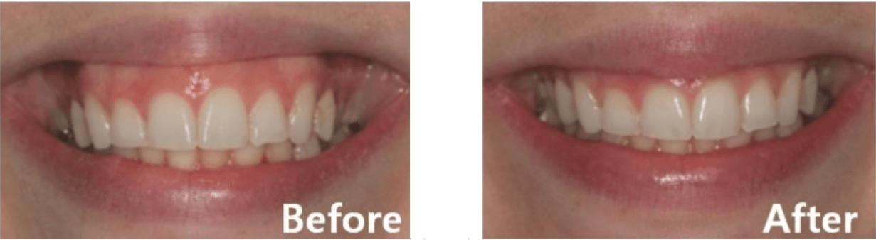 Gummy Smile Procedure (Non-1 Day Procedure)