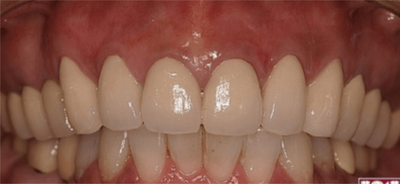 Gum Bleaching Gum Bleaching