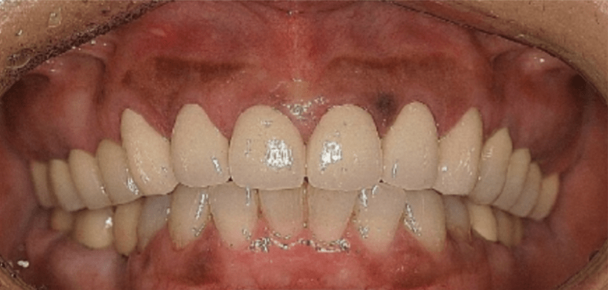 Gum Bleaching Gum Bleaching