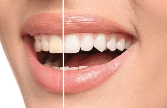 Home Teeth Whitening Kit: Everything You Need to Know