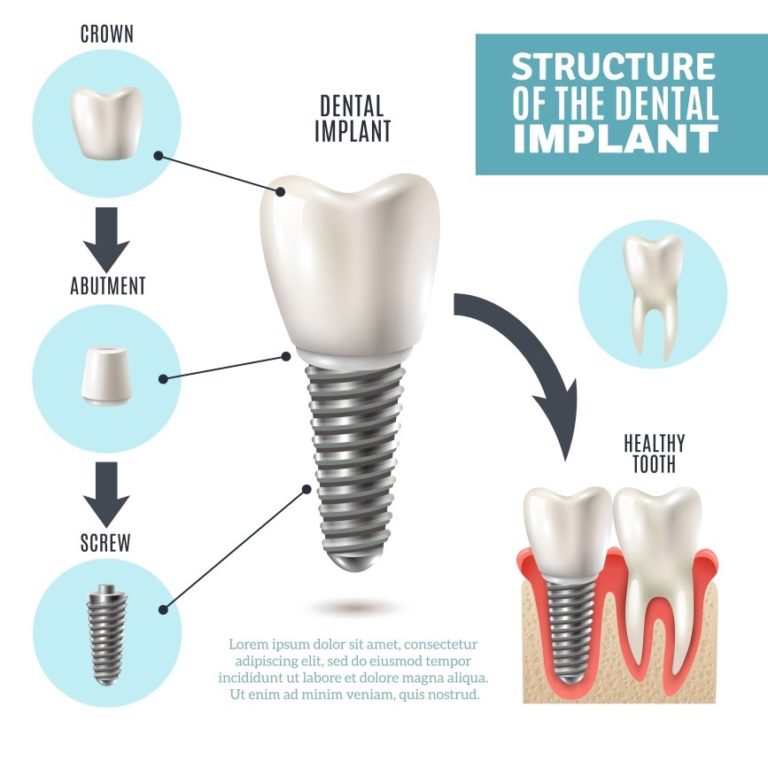 SURGICAL PROCEDURE OF DENTAL IMPLANTS Oaks Dental Korea