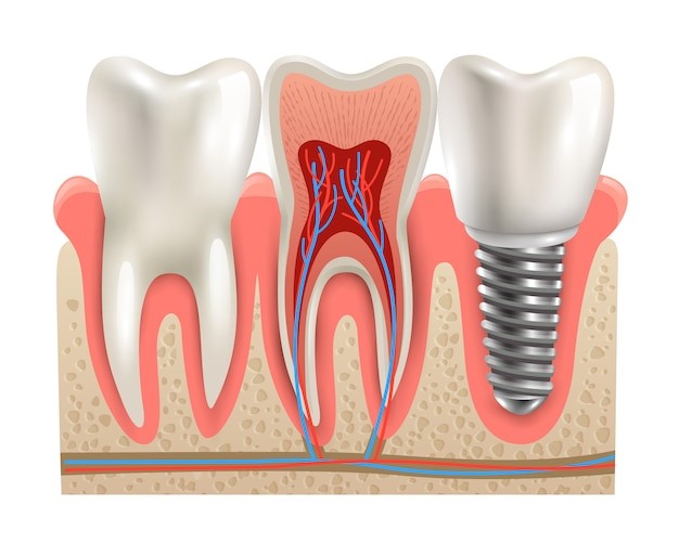 INDICATIONS OF DENTAL IMPLANT