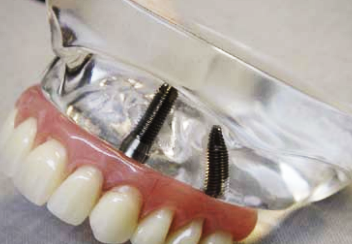 DENTAL IMPLANT A BONE SUPPORTED PROSTHESIS