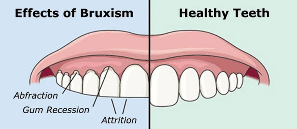 An In-depth Discussion of the Causes, Symptoms, Diagnosis and Treatment of Bruxism or Teeth Grinding